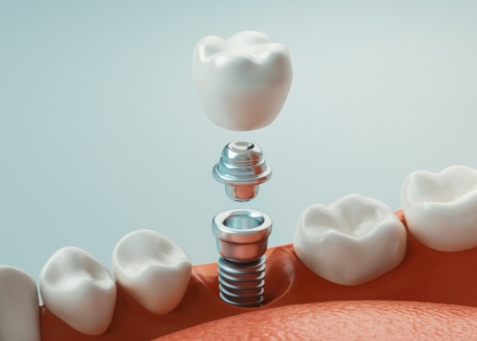 Illustrated model of dental implant in Bedford replacing a missing tooth