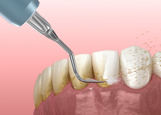 Illustrated dental instruments clearing plaque from teeth during gum disease treatment