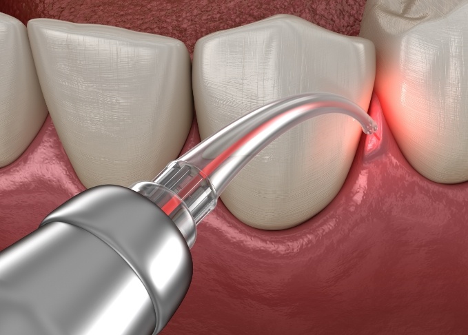 Illustrated soft tissue laser treating gum disease